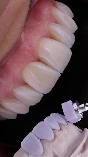 Modelagem de precisão em laboratório digital